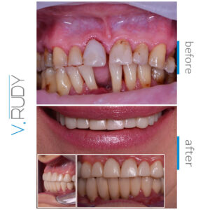 protez17-2